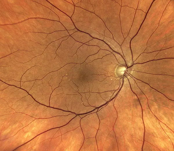 Close up of the back of the eye showing the macula and optic nerve