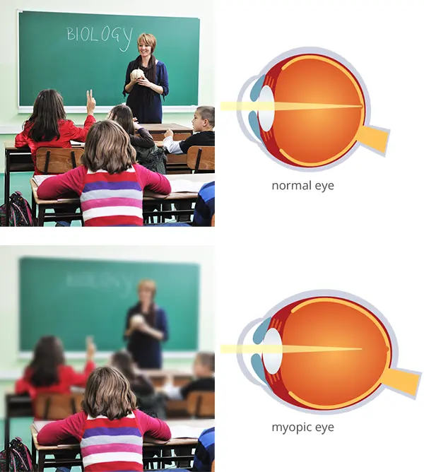 Myopia vision simulation